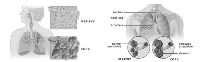 COPD Stem Cell Treatment - Chronic Obstructive Pulmonary Disease