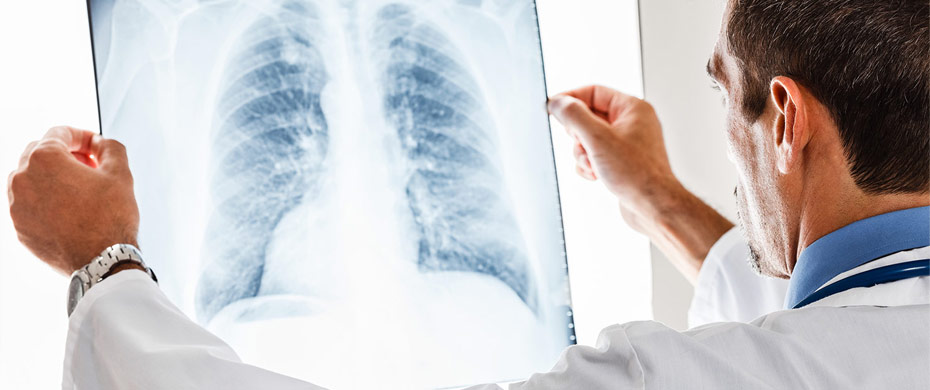 Chronic Obstructive Pulmonary Disease – COPD